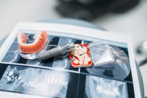 Dentures and pins on the table, dental prostheses